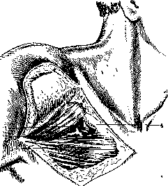 Mohrenheim's Fossa: figure 2 from the 1928–1936 encyclopedia article
