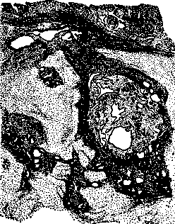 Adenomyoma: figure 1 from the 1928–1936 encyclopedia article